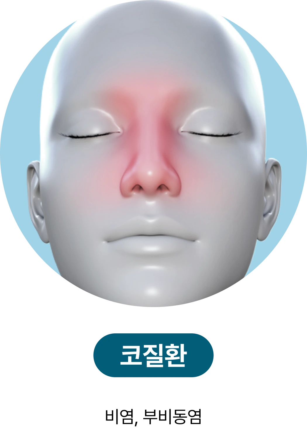 코질환: 비염, 부비동염