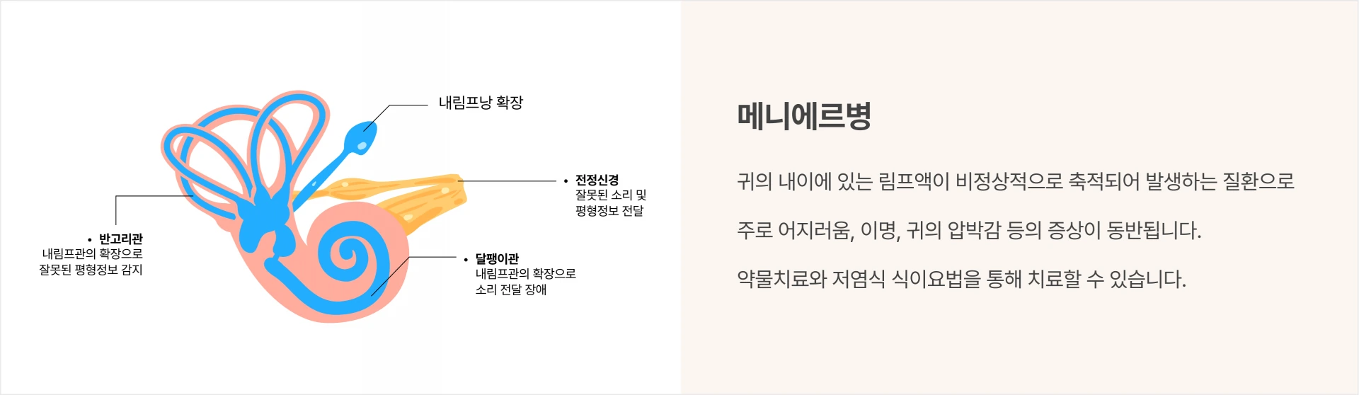 메니에르병: 귀의 내이에 있는 림프액이 비정상적으로 축적되어 발생하는 질환으로 주로 어지러움, 이명, 귀의 압박감 등의 증상이 동반됩니다. 약물치료와 저염식 식이요법을 통해 치료할 수 있습니다.