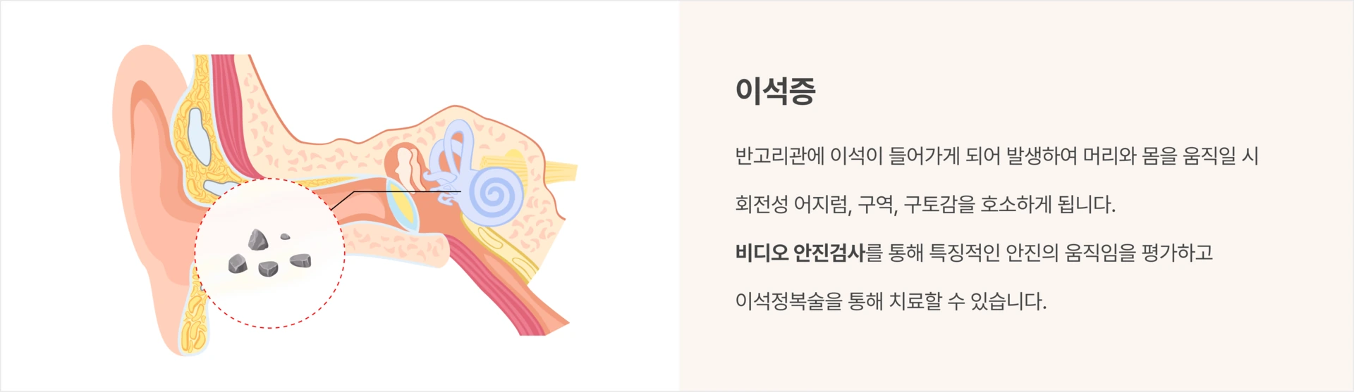 이석증: 반고리관에 이석이 들어가게 되어 발생하여 머리와 몸을 움직일 시 회전성 어지럼, 구역, 구토감을 호소하게 됩니다. 비디오 안진검사를 통해 특징적인 안진의 움직임을 평가하고 이석정복술을 통해 치료할 수 있습니다.