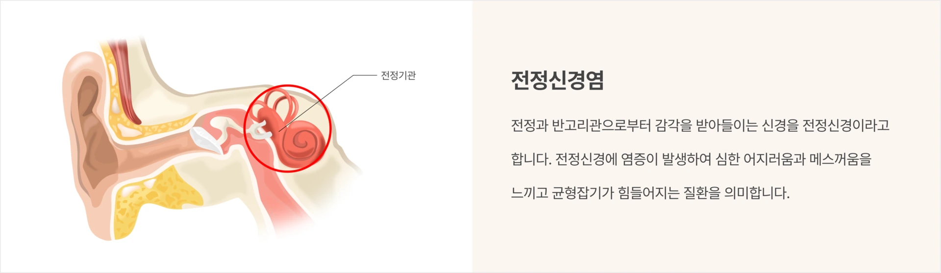 전정신경염: 전정과 반고리관으로부터 감각을 받아들이는 신경을 전정신경이라고 합니다. 전정신경에 염증이 발생하여 심한 어지러움과 메스꺼움을 느끼고 균형잡기가 힘들어지는 질환을 의미합니다.